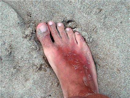 Pie-insolado